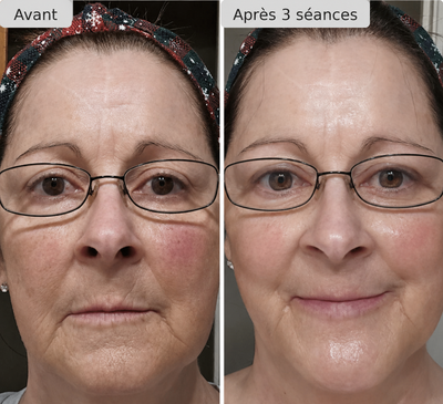 Nuvelle Facial Microinfusion