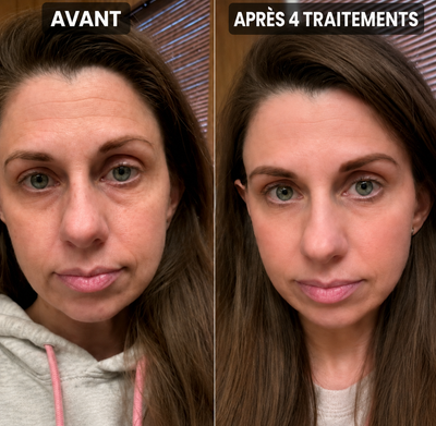 Nuvelle Facial Microinfusion