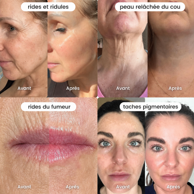 Nuvelle Facial Microinfusion