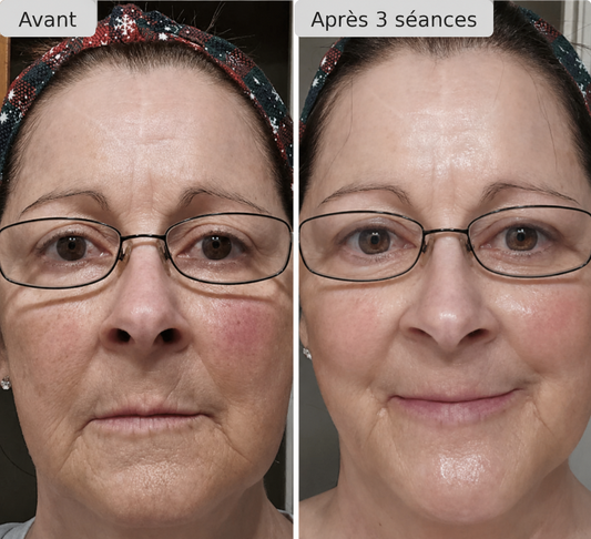Nuvelle Facial Microinfusion