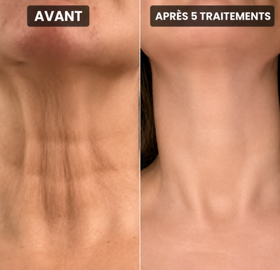Nuvelle Facial Microinfusion